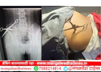 गजानन लोकसेवा हॉस्पिटलमध्ये दुर्मिळ व गुंतागुंतीची शस्त्रक्रिया यशस्वी; 9 वर्षाच्या मुलाच्या मणक्यातून कात्री काढली बाहेर