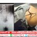 गजानन लोकसेवा हॉस्पिटलमध्ये दुर्मिळ व गुंतागुंतीची शस्त्रक्रिया यशस्वी; 9 वर्षाच्या मुलाच्या मणक्यातून कात्री काढली बाहेर