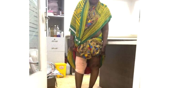 तब्बल दहा वर्षांनंतर स्वतःच्या पायावर उभी; महिलेवर गजानन लोकसेवा हॉस्पिटलमध्ये गुडघे प्रत्यारोपण शस्त्रक्रिया यशस्वी