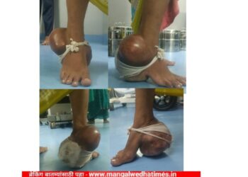 तब्बल चार वर्षानंतर महिला चालू लागली; कॅन्सरची गाठ काढून पाय केला बरा; गजानन लोकसेवा हॉस्पिटलमध्ये शस्त्रक्रिया यशस्वी