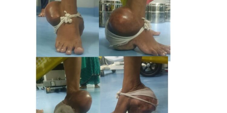 तब्बल चार वर्षानंतर महिला चालू लागली; कॅन्सरची गाठ काढून पाय केला बरा; गजानन लोकसेवा हॉस्पिटलमध्ये शस्त्रक्रिया यशस्वी