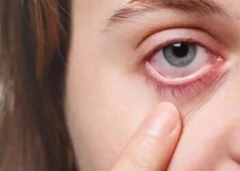 डोळ्याचा आजाराने मंगळवेढेकर हैराण! डोळे येणाऱ्या रुग्णांचे प्रमाण वाढले; अशी घ्या काळजी; काय आहेत लक्षणं आणि घरगुती उपाय?